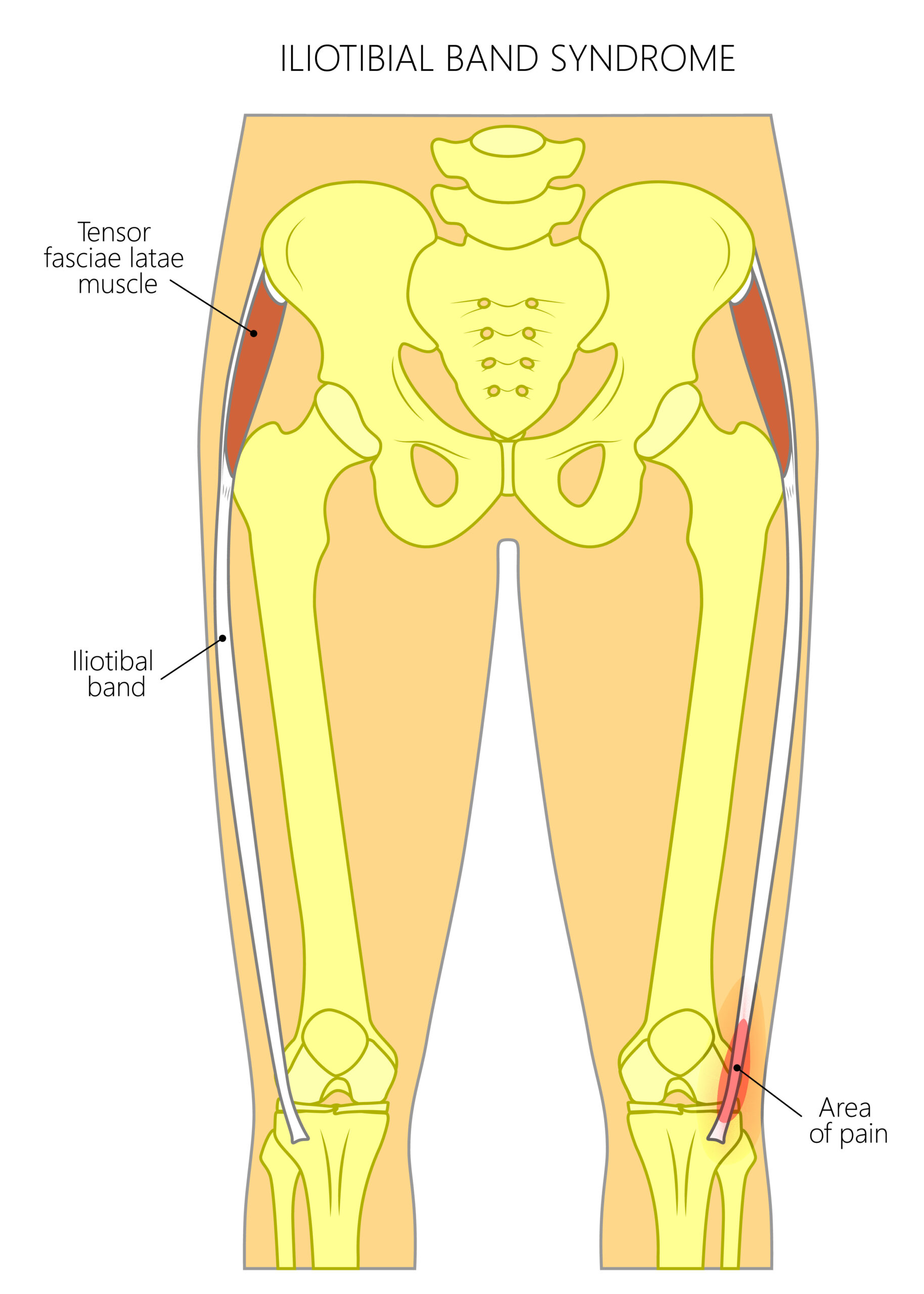 SINDROME DE LA CINTILLA ILIOTIBIAL O SINDROME DEL CORREDOR Fisiobalance