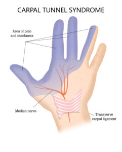 Síndrome tunel del carpo