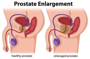 cancer de prostata fisiotetrapia